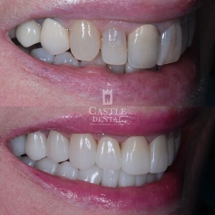 Full Mouth Restoration : Case 11