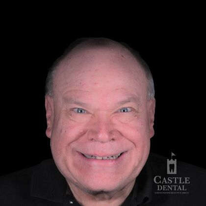 Zirconia Crowns Case 12 - Before