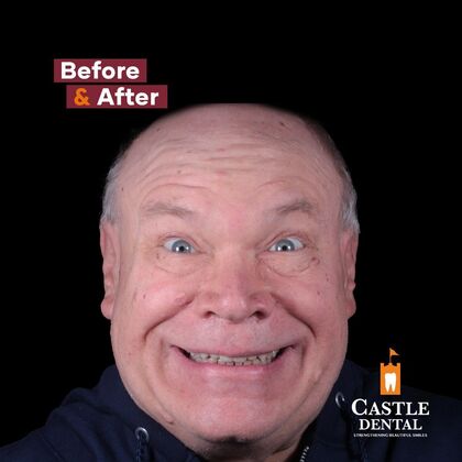 Zirconia Crowns Case 12 - After