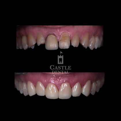 Zirconia Crowns: Case 12