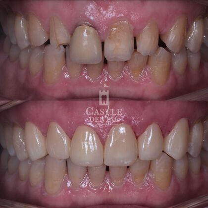 Zirconia Crowns: Case 12