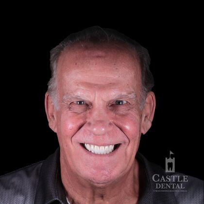 Full Mouth Restoration  Case 14 - After