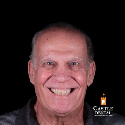 Full Mouth Restoration  Case 14 - Before