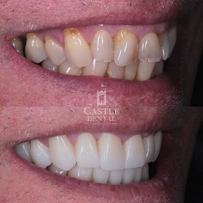 Full Mouth Restoration : Case 14