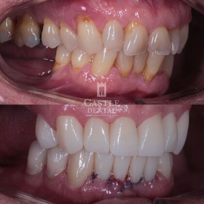 Full Mouth Restoration : Case 14