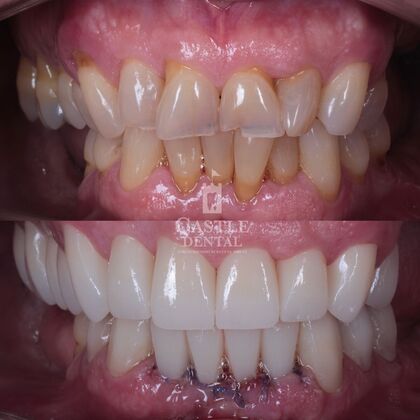 Full Mouth Restoration : Case 14