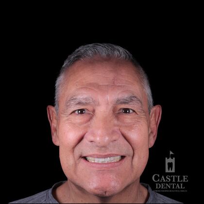 Full Mouth Restoration  Case 15 - Before