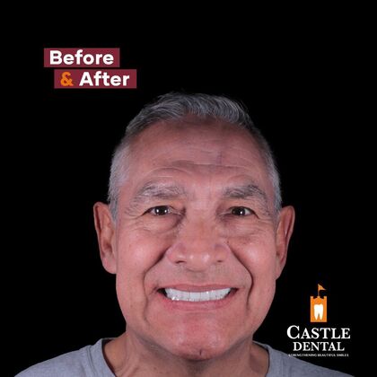 Full Mouth Restoration  Case 15 - After