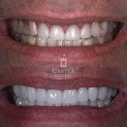 Full Mouth Restoration : Case 15