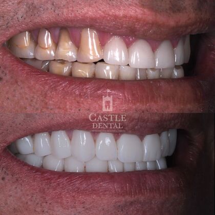 Full Mouth Restoration : Case 15