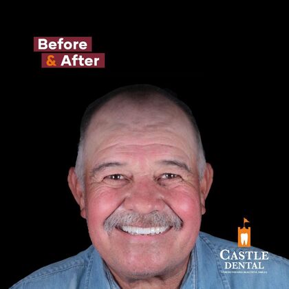 Full Arch Implants  Case 16 - After