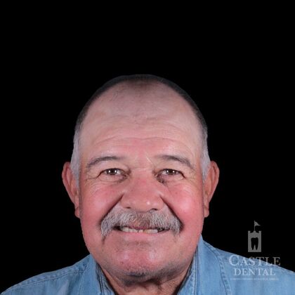 Full Arch Implants  Case 16 - Before