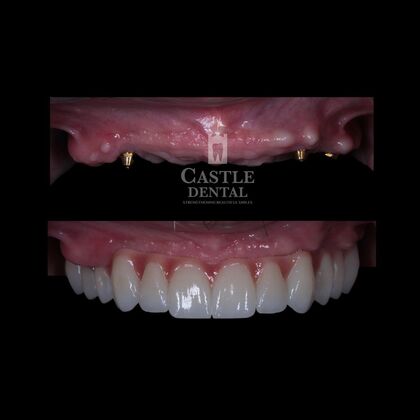 Full Arch Implants : Case 16