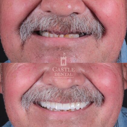 Full Arch Implants : Case 16