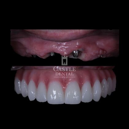 Full Arch Implants : Case 17