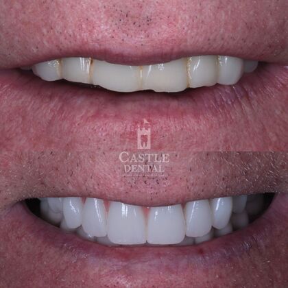 Full Arch Implants : Case 17