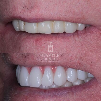 Full Arch Implants : Case 17