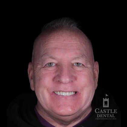 Full Arch Implants  Case 17 - Before