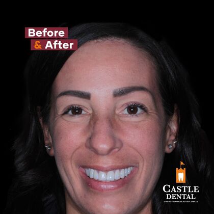 Full Mouth Restoration  Case 18 - After