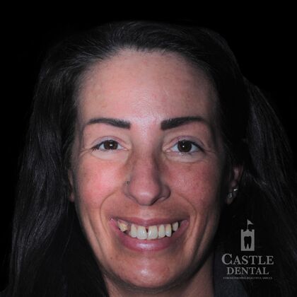 Full Mouth Restoration  Case 18 - Before