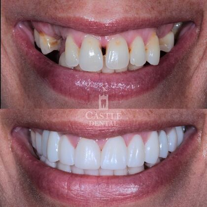 Full Mouth Restoration : Case 18