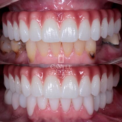 Full Arch Implants : Case 19