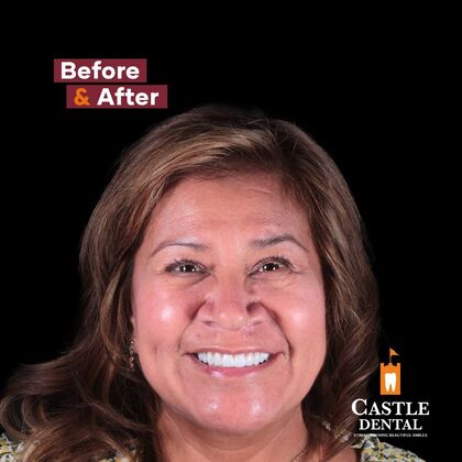 Full Arch Implants  Case 19