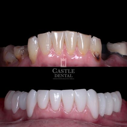 Full Arch Implants : Case 19