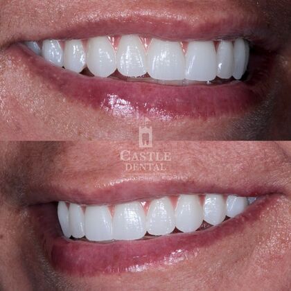 Full Arch Implants : Case 19