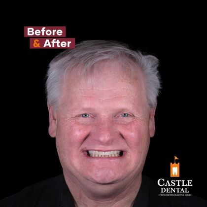 Full Mouth Restoration  Case 20 - After