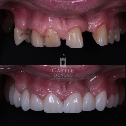 Full Mouth Restoration : Case 20 - Before