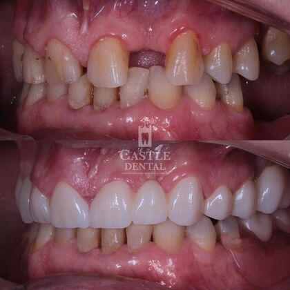 Full Mouth Restoration : Case 20 - After