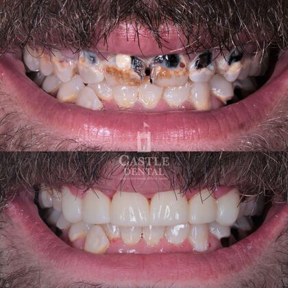 Zirconia Crowns: Case 21