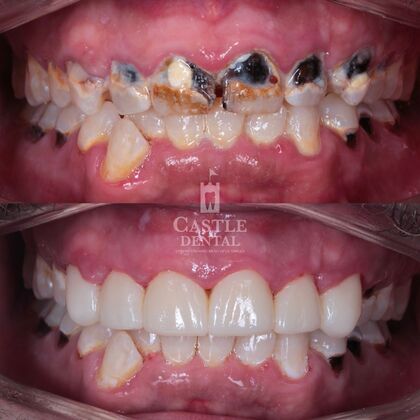 Zirconia Crowns: Case 21