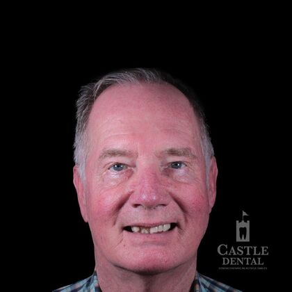 Removable Dentures Case 22 - Before