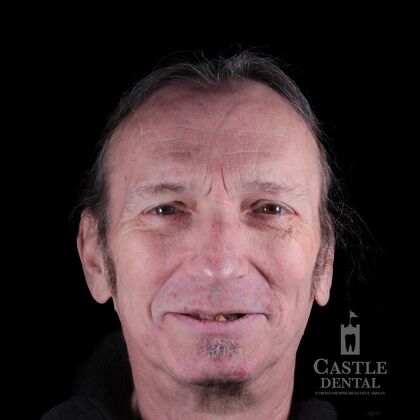 Full Arch Implants  Case 23 - Before