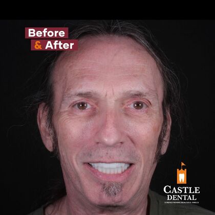 Full Arch Implants  Case 23 - After