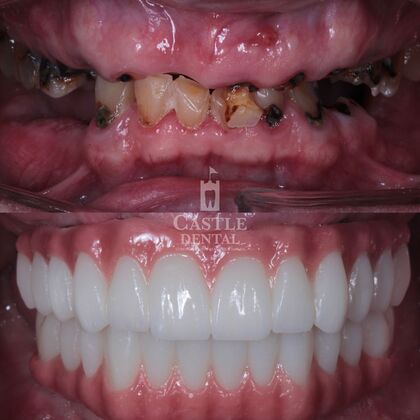 Full Arch Implants : Case 23 - Before