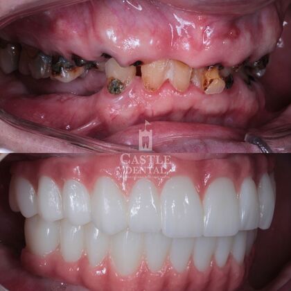 Full Arch Implants : Case 23