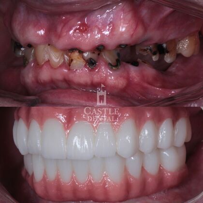 Full Arch Implants : Case 23