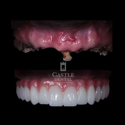 Full Arch Implants : Case 23