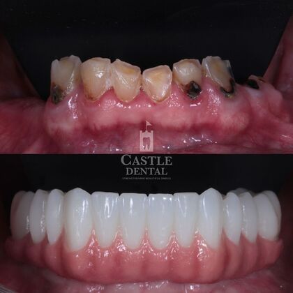 Full Arch Implants : Case 23