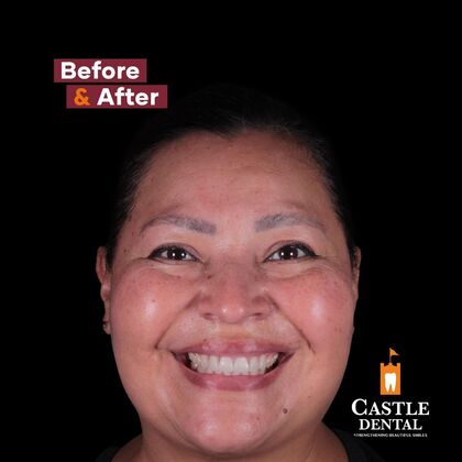 Porcelain Veneers Case 24 - After