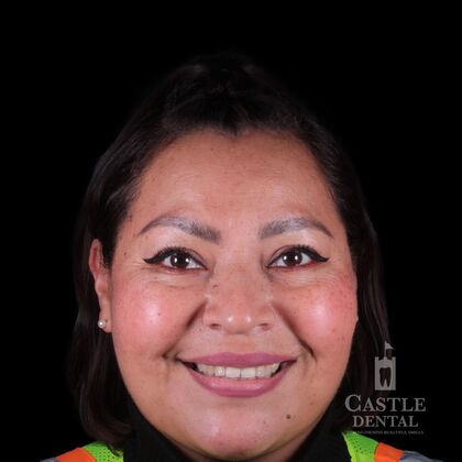 Porcelain Veneers Case 24 - Before