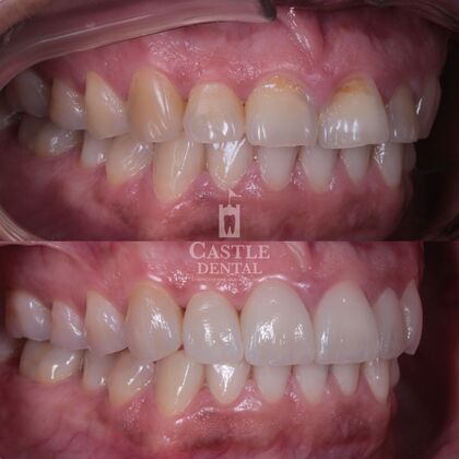 Porcelain Veneers: Case 24