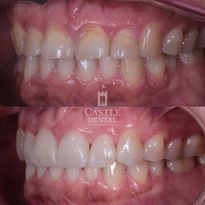 Porcelain Veneers: Case 24