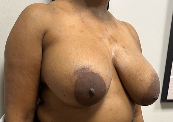 Breast Implant Removal: Case 43 - Before
