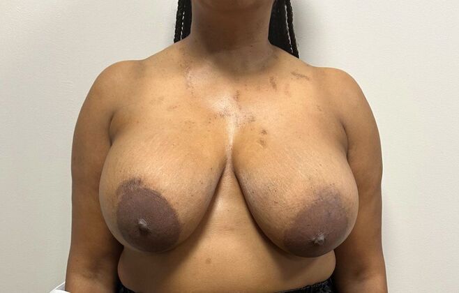 Breast Implant Removal: Case 43 - Before