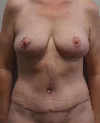 Mommy Makeover Case 314 - After