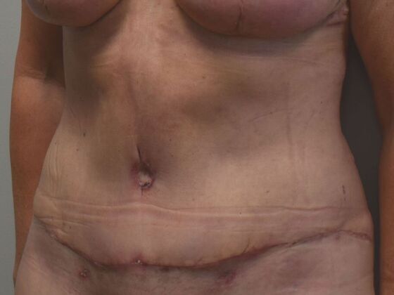 Tummy Tuck (Abdominoplasty): Case 492 - After